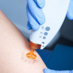 Treatment of Spider Veins with Medical Laser
